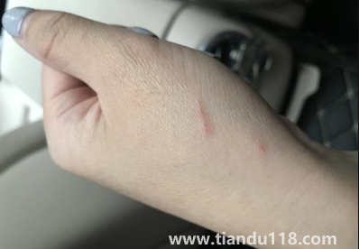 被貓抓了一下輕微破皮要打針嗎(被貓抓傷多少天過(guò)危險(xiǎn)期)(圖3) 被貓抓了一下輕微破皮要打針嗎3