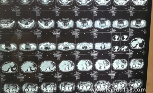 胰腺不舒服早期大便會(huì)變化嗎2