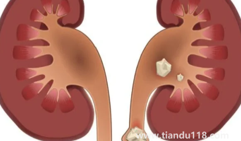 腎結(jié)石3mm×3mm多大2