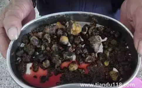 腎結(jié)石3mm×3mm多大3