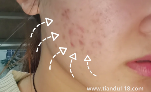 好幾年的痘印還發(fā)紅還能好嗎2