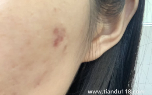 好幾年的痘印還發(fā)紅還能好嗎（皮膚不好有痘印怎么辦）